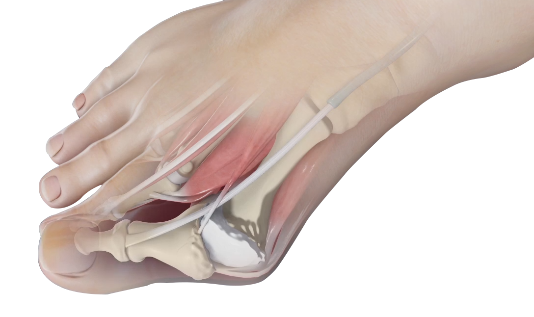 Bunion Correction