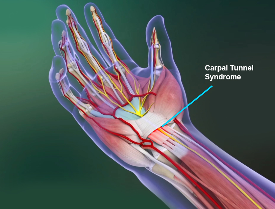 Carpal Tunnel Syndrome