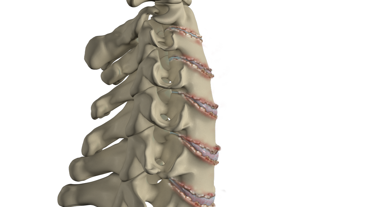 Spondylolysis