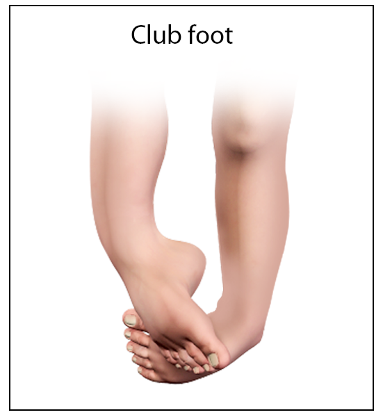 Club Foot Congenital Deformity Memphis Foot Deformity Memphis