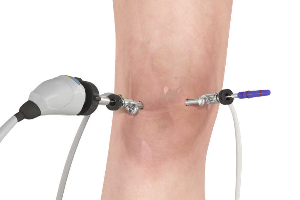 Knee Arthroscopy