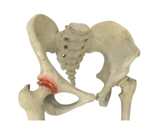 Osteoarthritis of the Hip