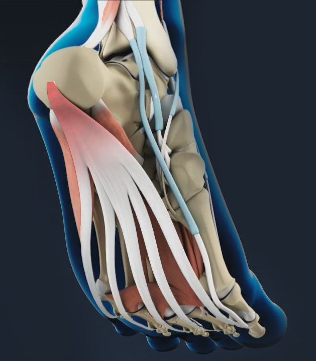 Plantar Fasciitis