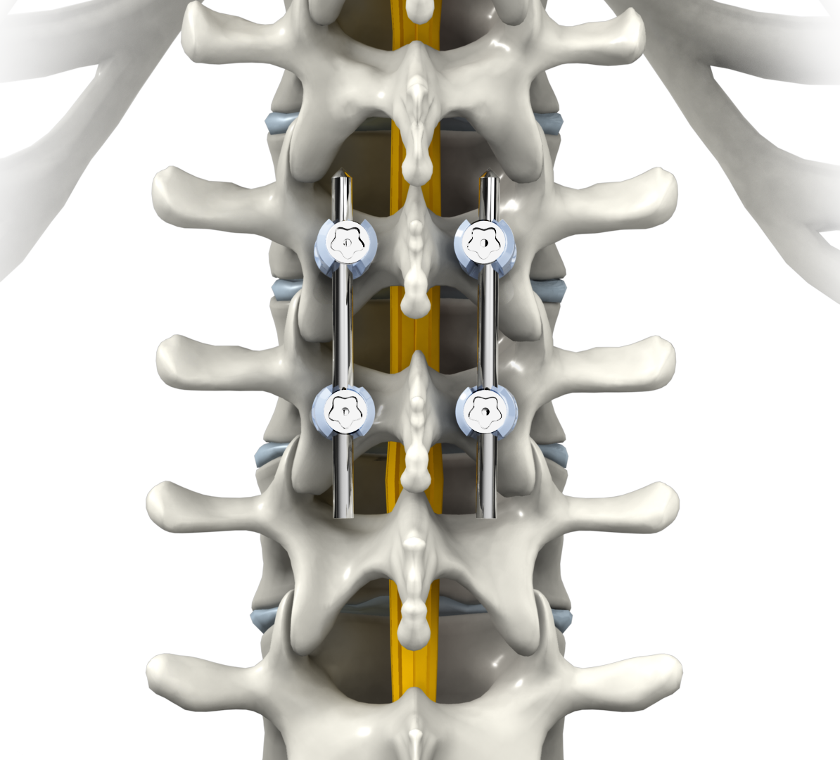 Spinal Fusion