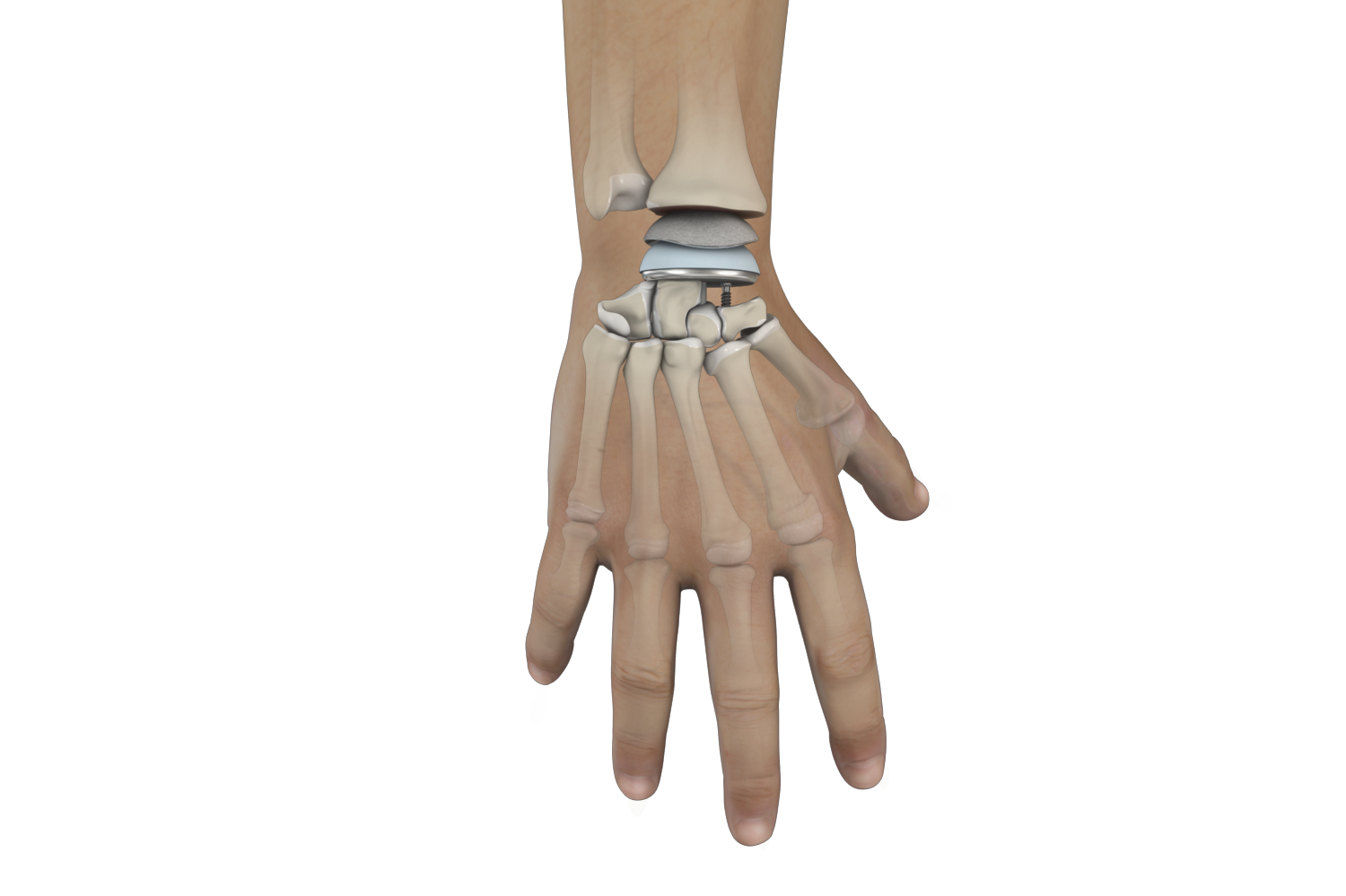 Wrist Joint Replacement