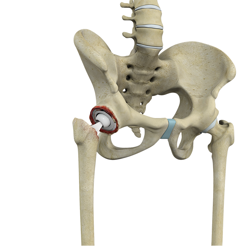 Revision Hip Replacement